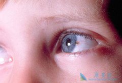 ����ҽ�ƽ�����α���۾��׺�ɫ������֢״��