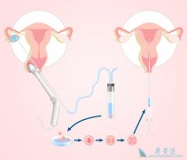 掌握试管婴儿移植后注意事项有利于提高胚胎存活率