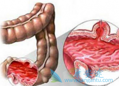 ������(REGORAFENIB)�������CRC�Ŀ����ʺͽ�����������