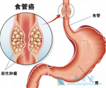 ��ķ����(Pembrolizumab)����θʳ�ܽ����԰�֢��Ч����ô��