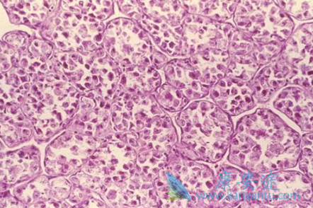 软组织肉瘤 软组织肉瘤