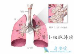 ��Сϸ���ΰ��Ĺ�ת�Ƶ�֢״��ʲô����������ƣ�