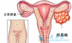 PARP���Ƽ���������(Olaparib)�ڶԿ�������������Щ����