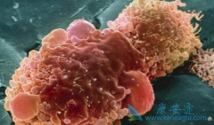 ��������(Cabozantinib)�ڷ�Сϸ���ΰ�����������ЩӦ��