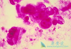 ���ᵥ��(Panitumumab)���ϻ����������������ٰ���Ч����