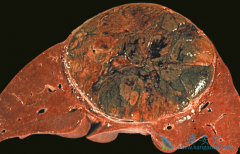 �̿����Ƶ��ַ�����(Lenvima)������ΰ����߶���������