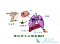 �ΰ���ת��֢״��������ת�Ƶĳ�����λ