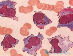 ��������(Carfilzomib)ÿ��һ�����ƶ෢�Թ�����Ч������