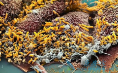 ��άĪ˾(Afinitor)�ܸ��ƽ�չ��θ�����ߵ���������