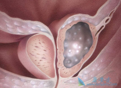 ��������(Abiraterone)����Ч����ǰ���ٰ��������ںϳ��ۼ��ص�ø