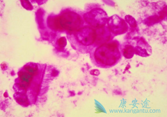 ��Ī����(Nolvadex)�����ڼ仼�����Ԥ���ӹ���Ĥ������