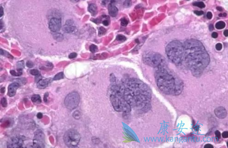 鲁索替尼 鲁索替尼