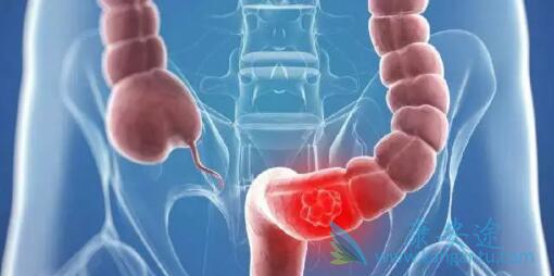 直肠癌症状 直肠癌症状
