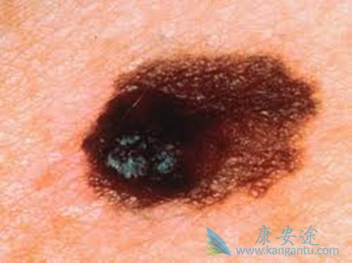 黑色素瘤是什么 黑色素瘤是什么
