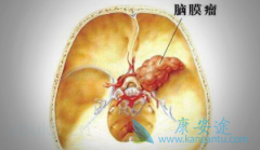 ������Ĥ������ѡ��٤�����ܳ���ɱ����ϸ����