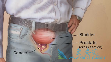 前列腺癌 前列腺癌