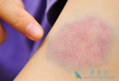 ��Ѫ���ĳ���֢״�ͷ�����Ѫ����ԭ��