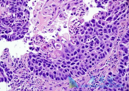 肺鳞状细胞癌 肺鳞状细胞癌