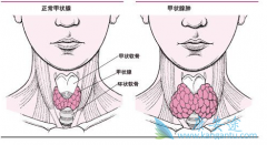 RET�ں����Եļ�״�ٰ�������ҩLOXO-292������Ч��