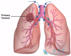 �������(Dacomitinib)����Ϊ���ڷ�Сϸ���ΰ����ߵ�һ����ҩ��