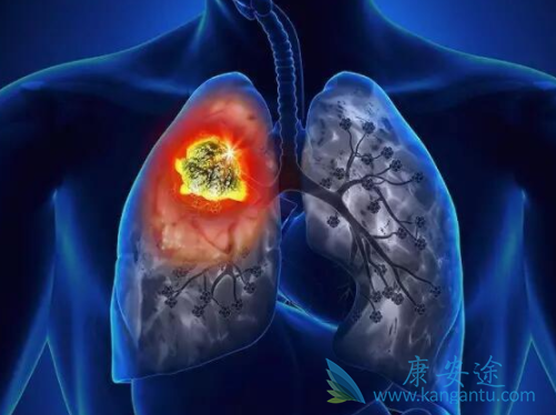 鳞状细胞癌 鳞状细胞癌