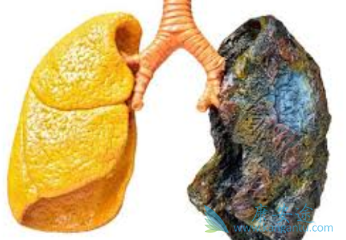 特发性肺纤维化 特发性肺纤维化