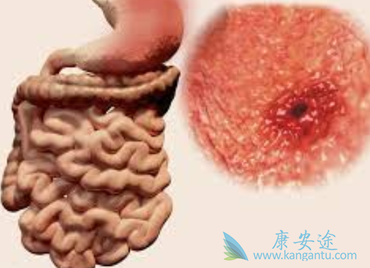 胃肠道间质瘤 胃肠道间质瘤