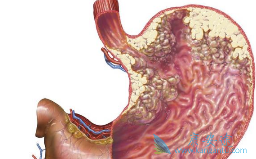 幽门螺旋杆菌 幽门螺旋杆菌