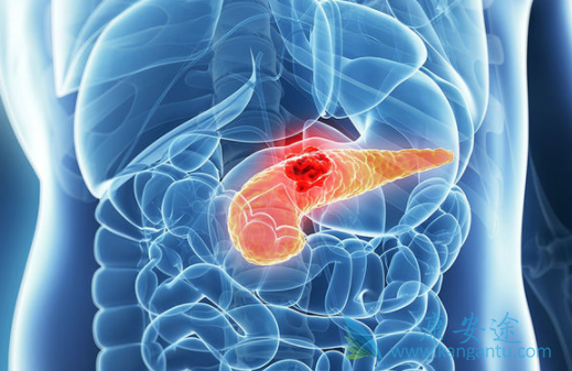 胰腺癌治疗 胰腺癌治疗