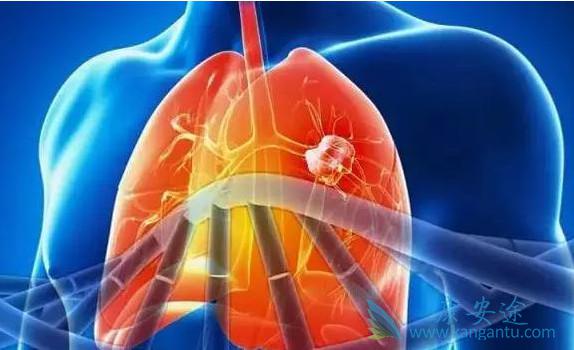 肺癌脑转移 肺癌脑转移