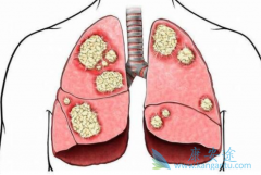 PD-L1����Atezolizumab����Сϸ���ΰ�Ч����ô��