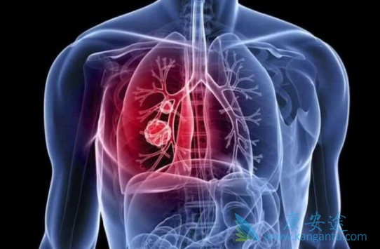 非小细胞肺癌 非小细胞肺癌