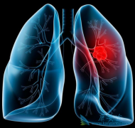 �߱���Щ������ALK���Էΰ����߿�ʹ����������(Lorlatinib)��