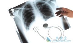 EGFR-TKI���ϻ����ܸ��Ʒ�Сϸ���ΰ���һ��������