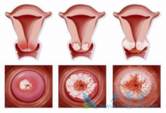 HPV���������ƹ�������HPV�������Ч����ʱ���Ƕ�ã�