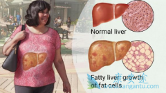 �����Ǿƾ���֬���Ը��ף�NASH����ҩ���FDA����ͨ���ʸ�