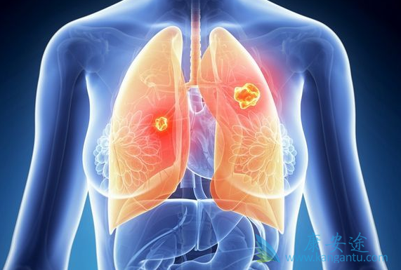肺癌晚期 肺癌晚期