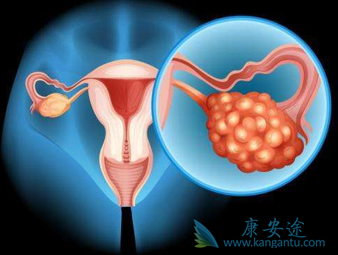 卵巢癌治疗;卵巢癌 卵巢癌治疗;卵巢癌