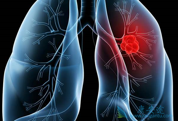 转移性肺癌 转移性肺癌