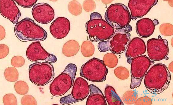 慢粒性白血病 慢粒性白血病