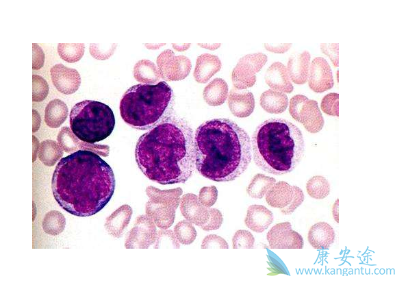 慢粒性白血病 慢粒性白血病
