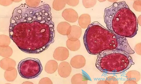 霍奇金淋巴瘤 霍奇金淋巴瘤