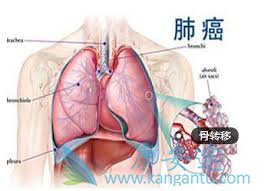 ȷ�Ϸΰ���ת��֢״��Ӧ���������